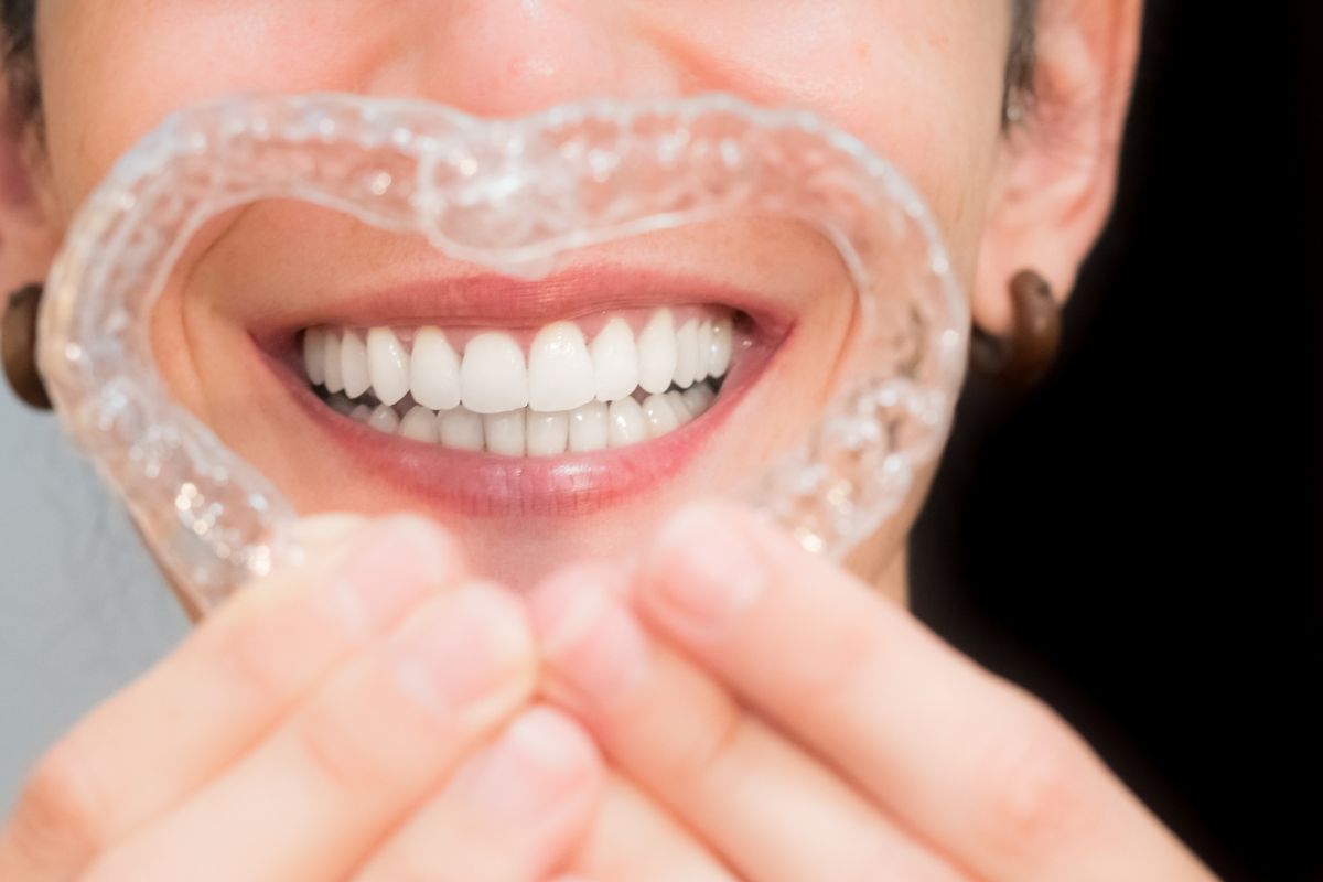 Beneficios de la ortodoncia invisible - Clínica dental mayor 4