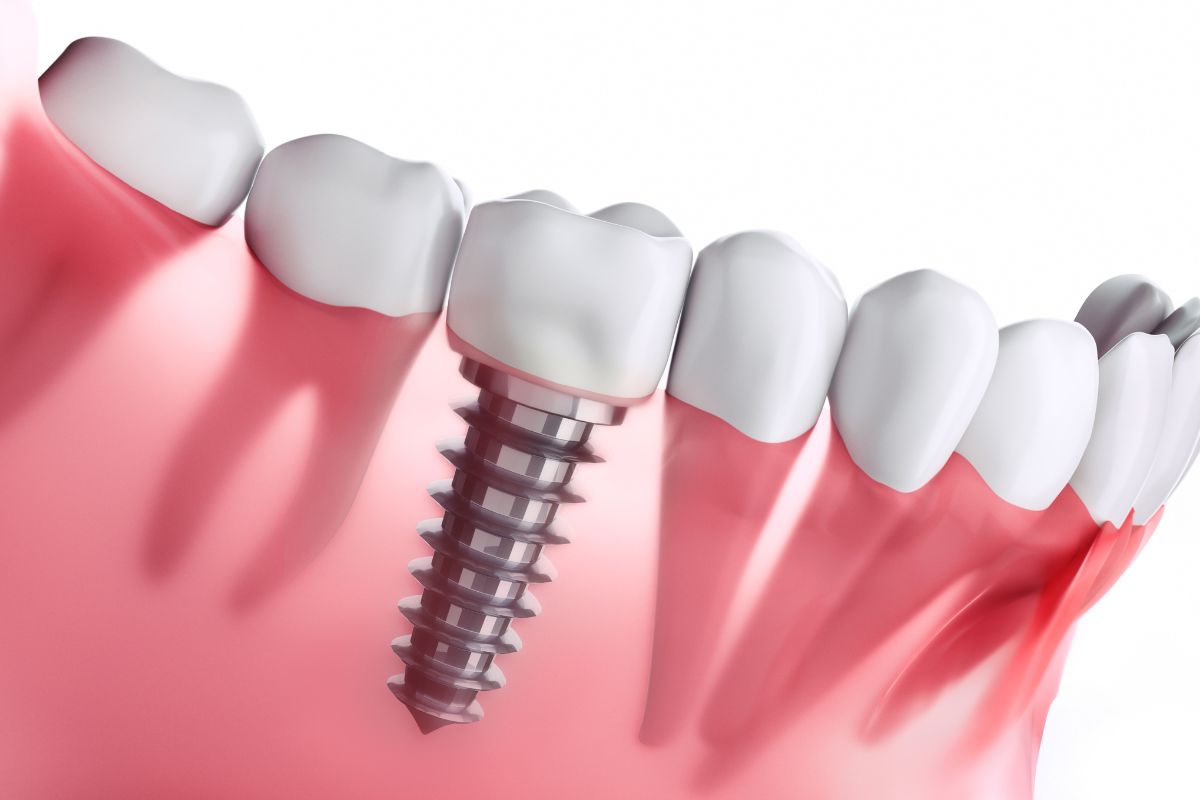 Lee más sobre el artículo Ventajas de los implantes dentales