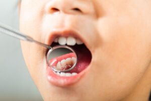 Lee más sobre el artículo Dentista para niños en Reinosa